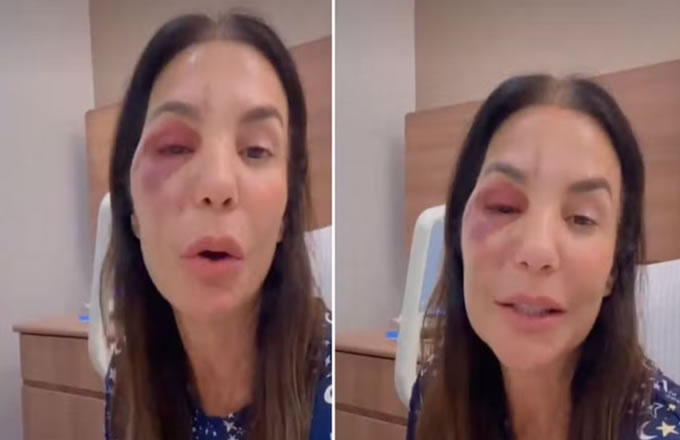 Ivete Sangalo reaparece nas redes sociais após cirurgia no rosto